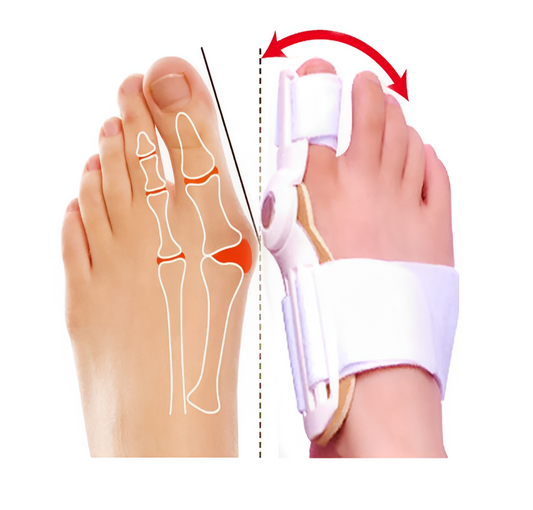 Bunex™ - Corrector de juanetes
